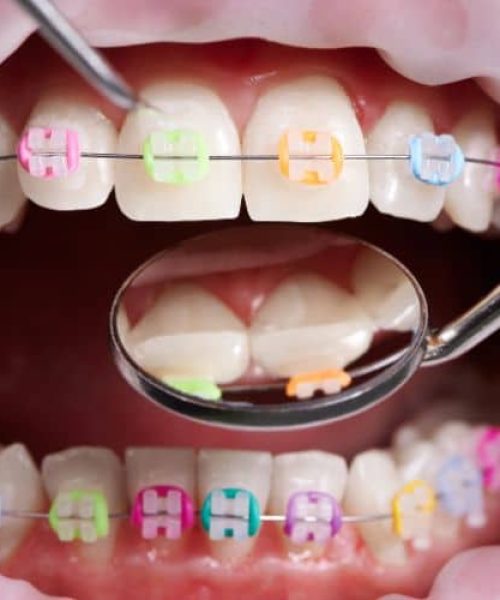 bague-dentaire-orthodontie